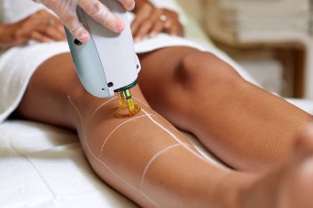 Lazer Epilasyon Nedir